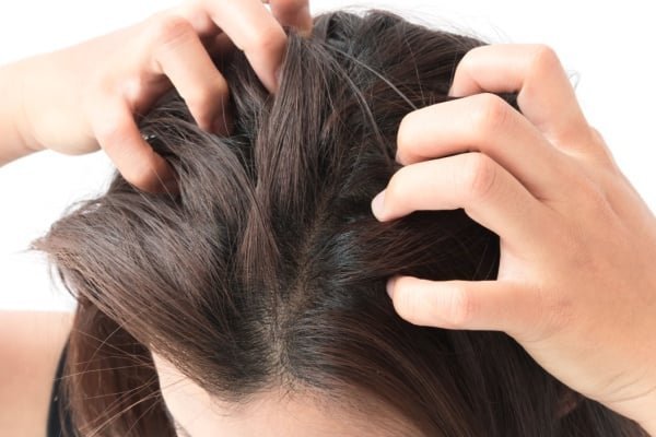 Causes & Solutions of Dandruff
